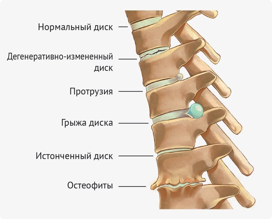 Lumbar Osteochondrose Discompti