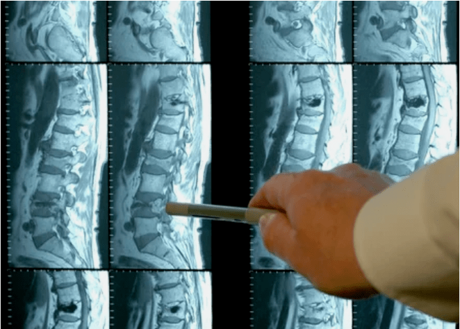 Osteochondrose varieties in spine