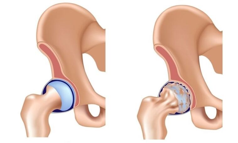 A healthy wrist and joint with arthrosis
