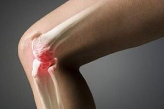 Knee wrist arthrosis is a cartilage tissue lesion