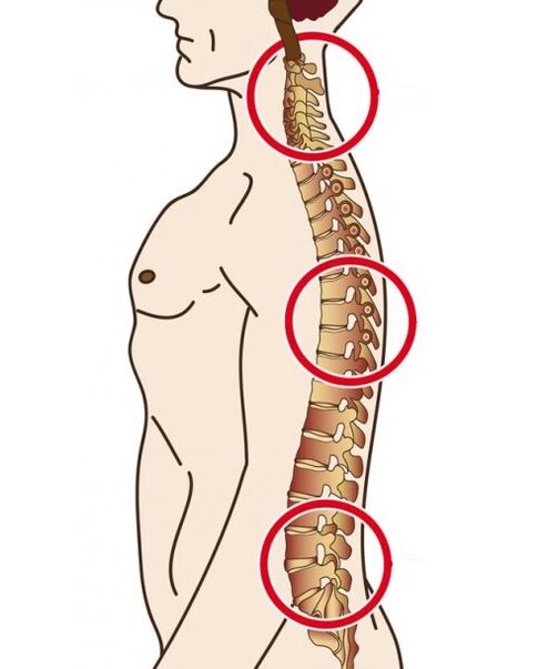 Spinal departments in which osteochondrosis appears
