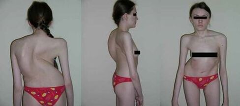 The curvature of the spine as a result of osteochondrose