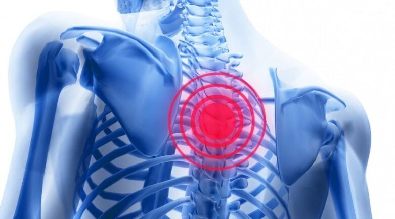 back pain can be the result of a herniated disc