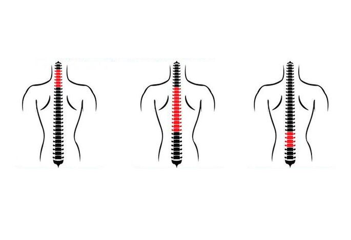 How does osteochondrosis manifest itself