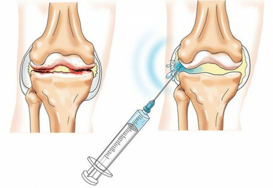 injection into the knee joint in arthrosis