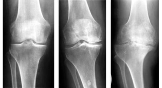 An obligatory diagnostic measure for the identification of knee arthrosis is an X-ray