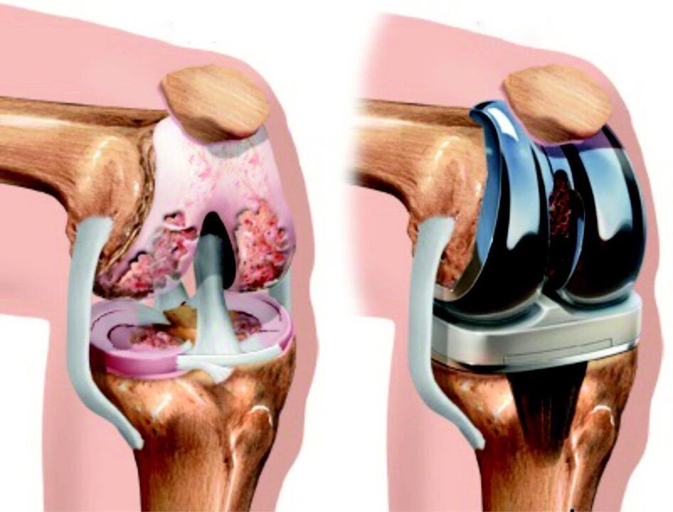 In case of total damage to the knee joint due to arthrosis, it can be restored with endoprosthetics